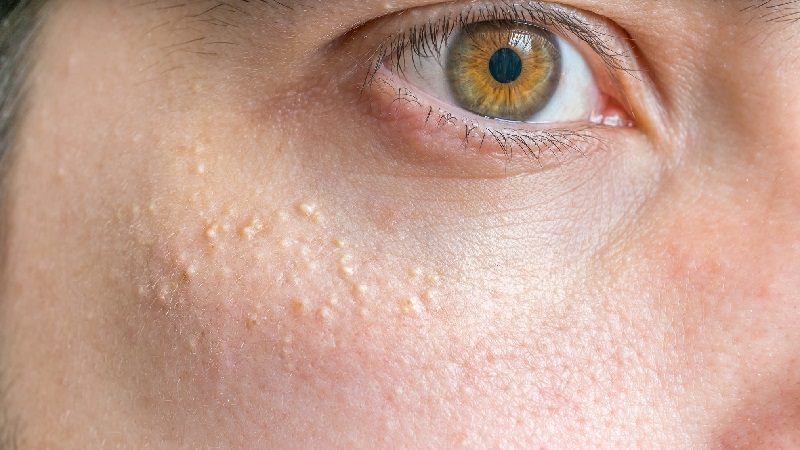 What Is Milialar? - Causes, Types, and Treatments