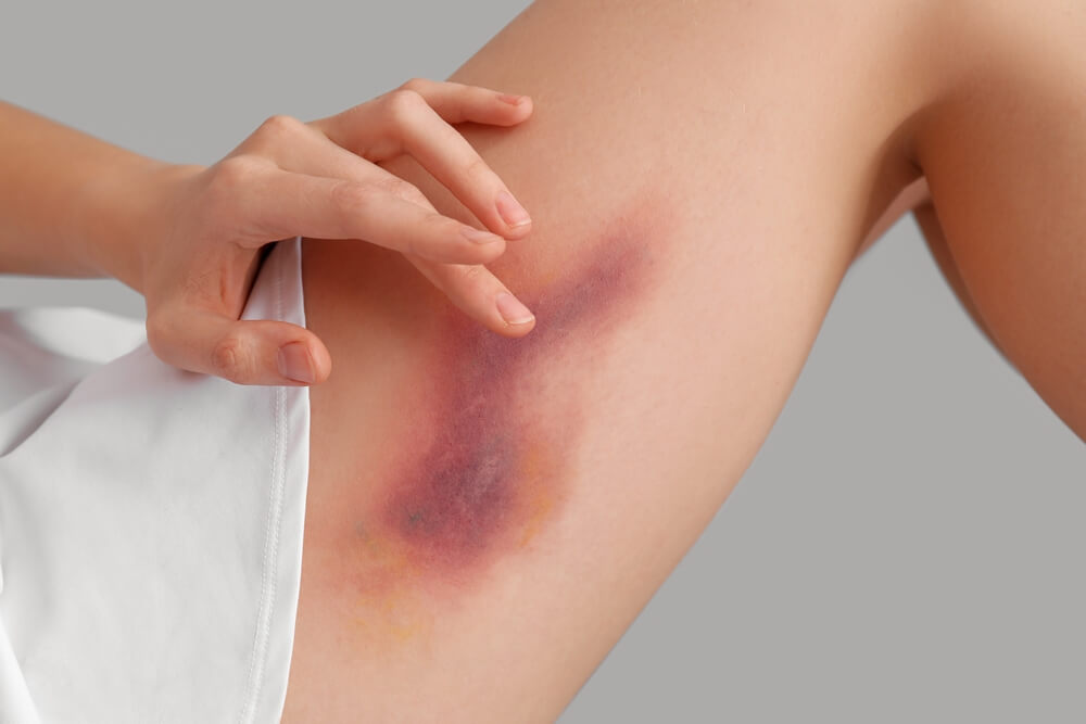 10 Best Essential Oils for Bruises