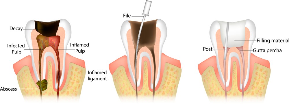 Effects of Root Canal Treatment on Driving Ability