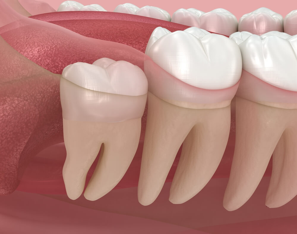 Molar Breaks Off at the Gum Line