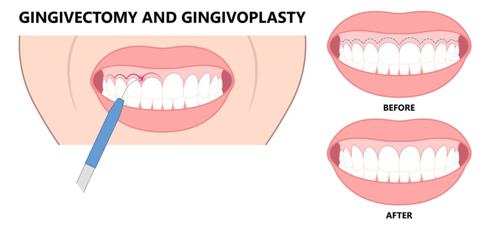 Potential Risks and Complications