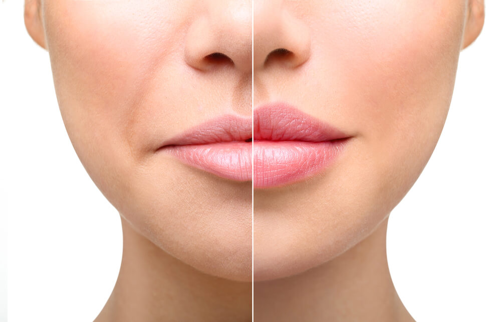 before and after Nasolabial Fold Fillers