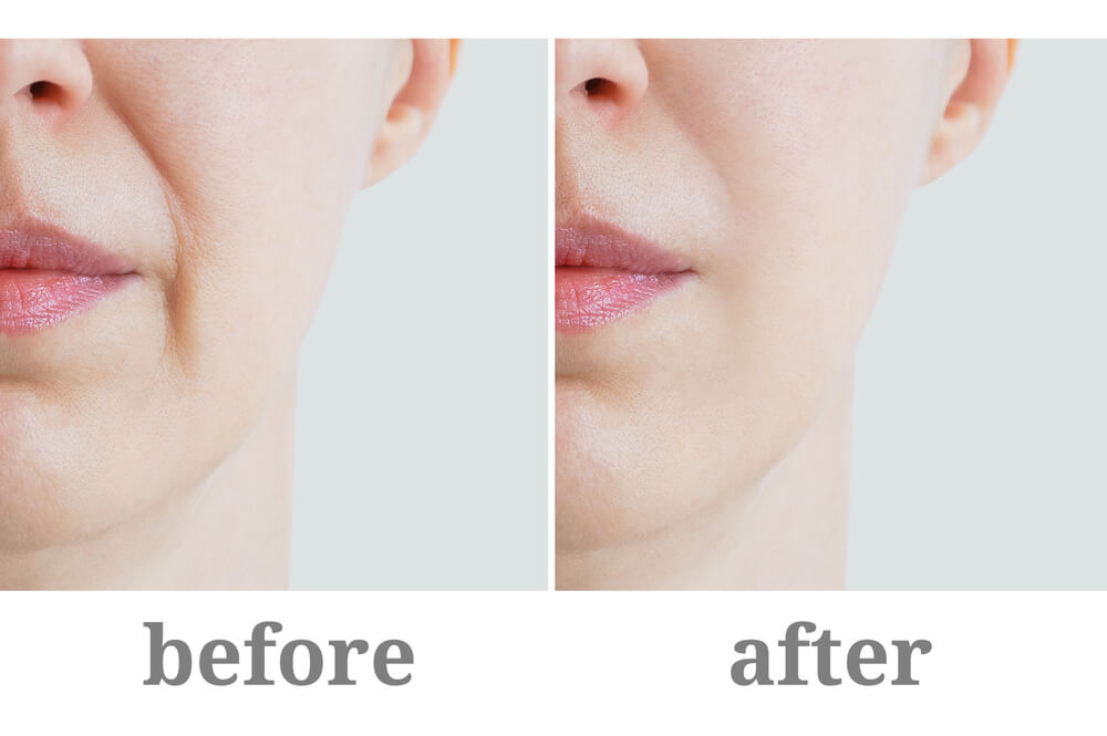 before and after of Nasolabial Fold Fillers