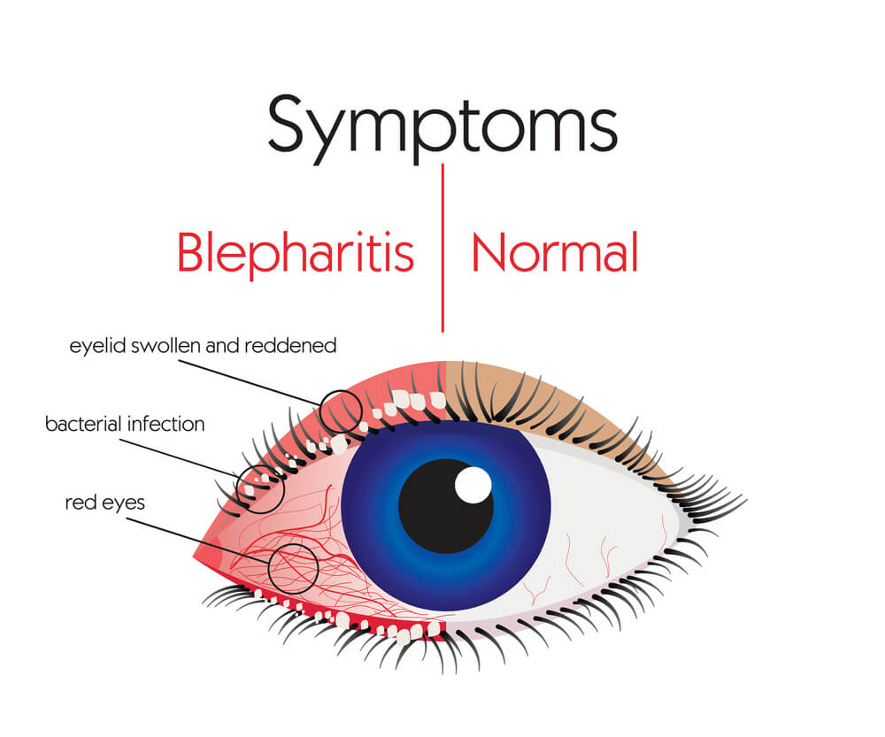 symptoms of blepharitis